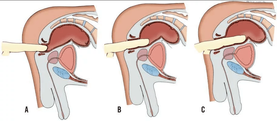 Exame rectal de dedos