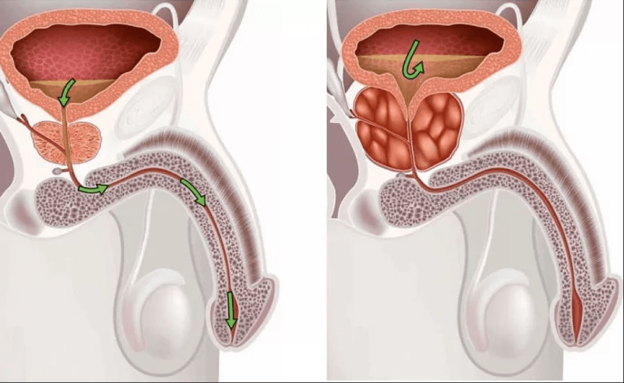 Síntomas da prostatite